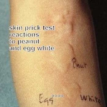 Skin prick test results demonstrating reactions to various food allergens on a patient's forearm.