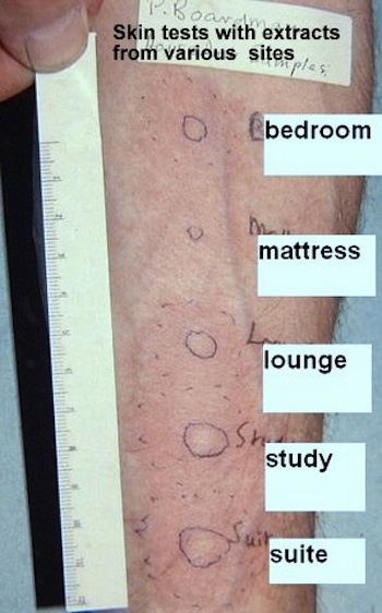 Skin prick tests on a patient's back showing a wide range of positive reactions to suspected allergens from multiple indoor and outdoor locations.