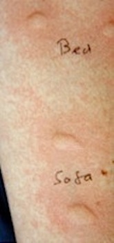 Allergy clinician performing a skin prick test