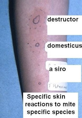 Skin test results showing differing allergic reactions (wheals) to extracts of house dust mites and various storage mites.